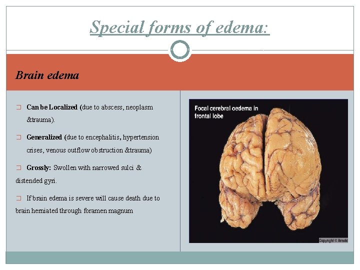 Special forms of edema: Brain edema � Can be Localized (due to abscess, neoplasm