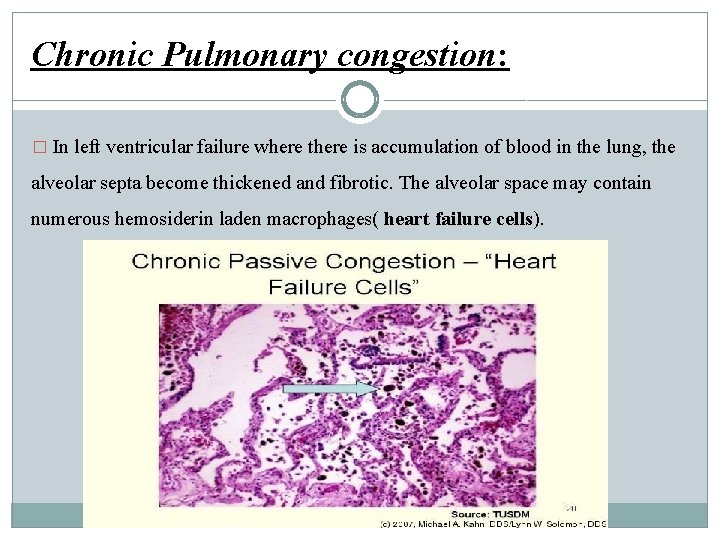 Chronic Pulmonary congestion: � In left ventricular failure where there is accumulation of blood