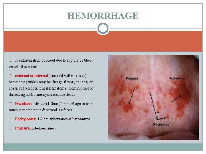 HEMORRHAGE � Is extravasation of blood due to rupture of blood vessel. It is