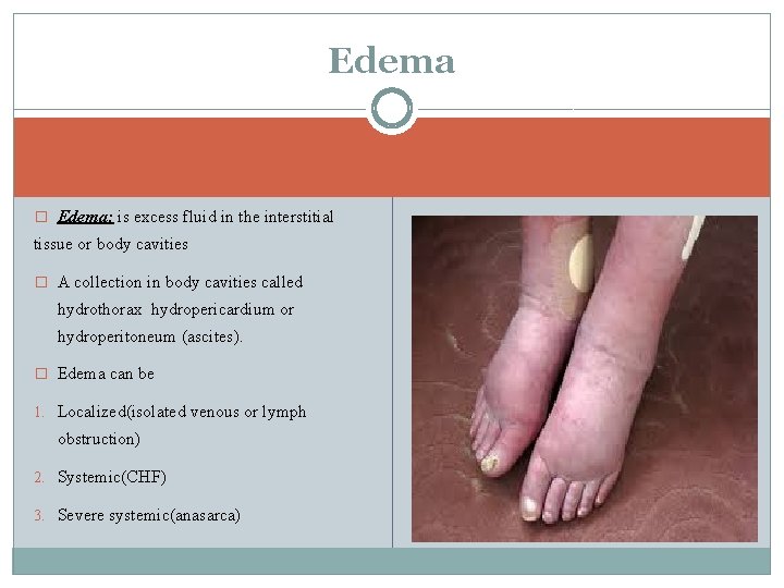 Edema � Edema: is excess fluid in the interstitial tissue or body cavities �