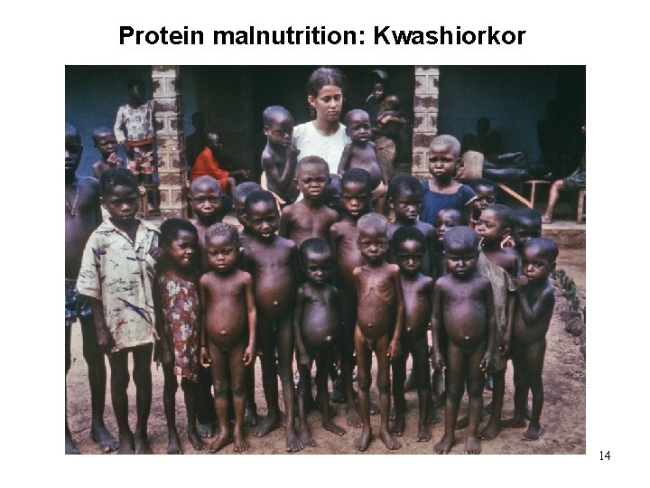 Protein malnutrition: Kwashiorkor 14 