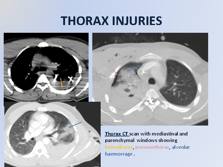 THORAX INJURIES Thorax CT scan with mediastinal and parenchymal windows showing hemothorax, pneumothorax, alveolar