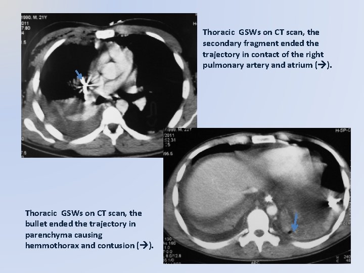 Thoracic GSWs on CT scan, the secondary fragment ended the trajectory in contact of