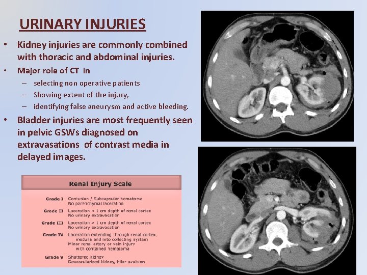 URINARY INJURIES • Kidney injuries are commonly combined with thoracic and abdominal injuries. •