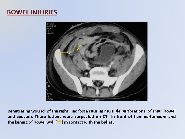 BOWEL INJURIES penetrating wound of the right iliac fossa causing multiple perforations of small