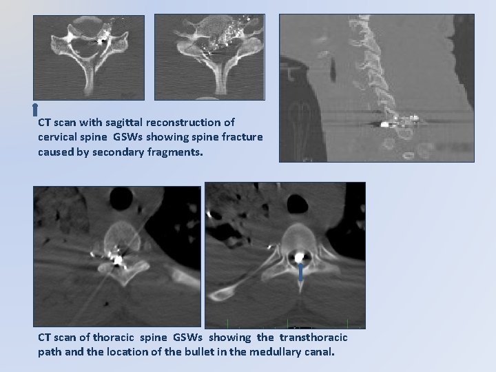CT scan with sagittal reconstruction of cervical spine GSWs showing spine fracture caused by