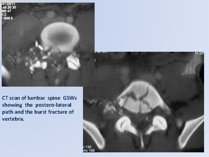 CT scan of lumbar spine GSWs showing the postero-lateral path and the burst fracture