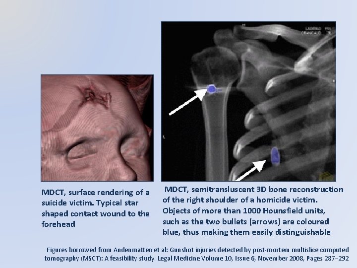 MDCT, surface rendering of a suicide victim. Typical star shaped contact wound to the