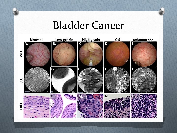 Bladder Cancer 