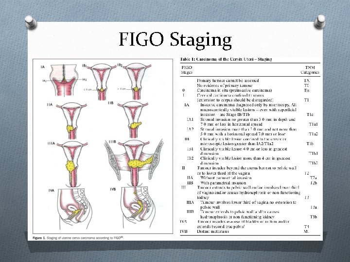 FIGO Staging 
