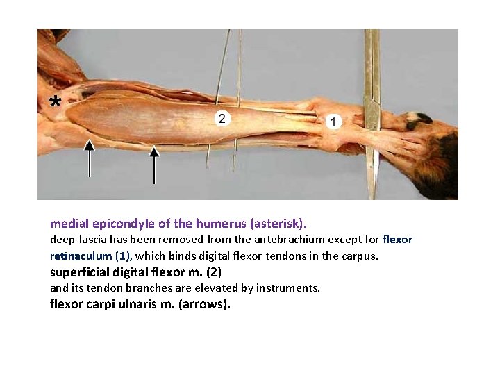 medial epicondyle of the humerus (asterisk). deep fascia has been removed from the antebrachium