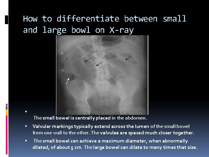 How to differentiate between small and large bowl on X-ray The small bowel is