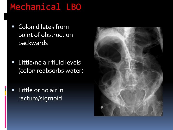 Mechanical LBO Colon dilates from point of obstruction backwards Little/no air fluid levels (colon