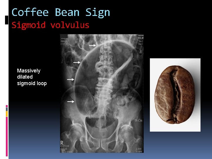 Coffee Bean Sigmoid volvulus Massively dilated sigmoid loop 