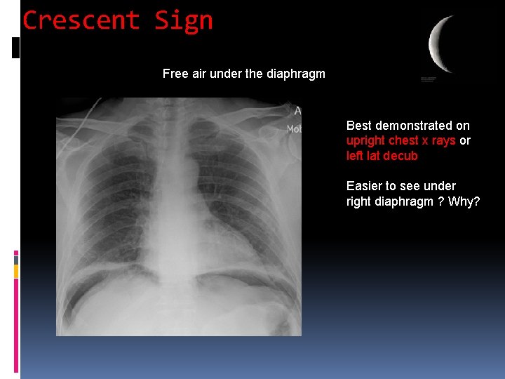 Crescent Sign Free air under the diaphragm Best demonstrated on upright chest x rays