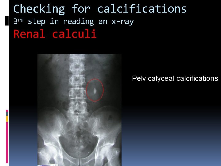 Checking for calcifications 3 rd step in reading an x-ray Renal calculi Pelvicalyceal calcifications
