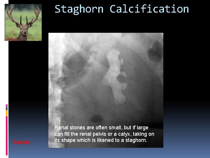 Staghorn Calcification Tubular Renal stones are often small, but if large can fill the