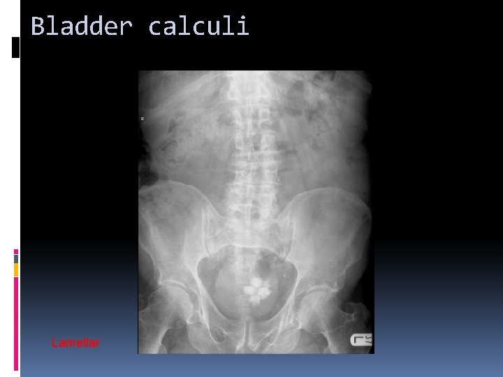 Bladder calculi Lamellar 