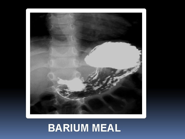 BARIUM MEAL 