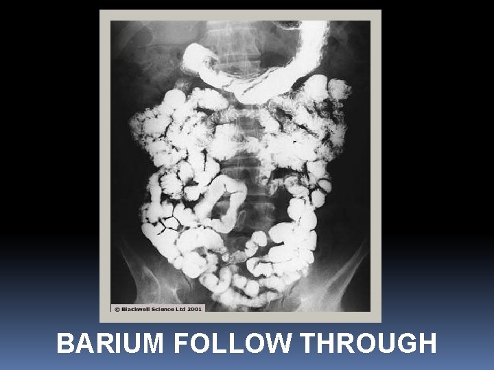 BARIUM FOLLOW THROUGH 