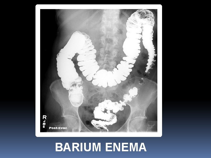 BARIUM ENEMA 