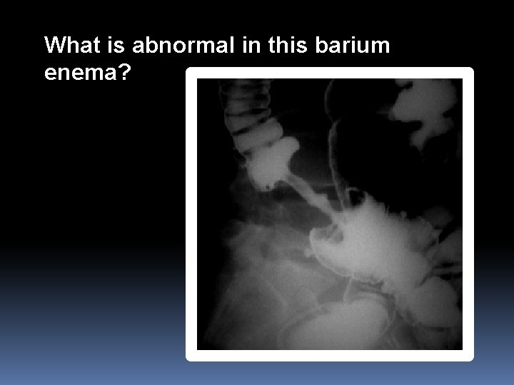 What is abnormal in this barium enema? 