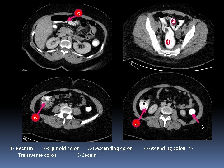 5 2 1 6 1 - Rectum 2 -Sigmoid colon 3 -Descending colon Transverse