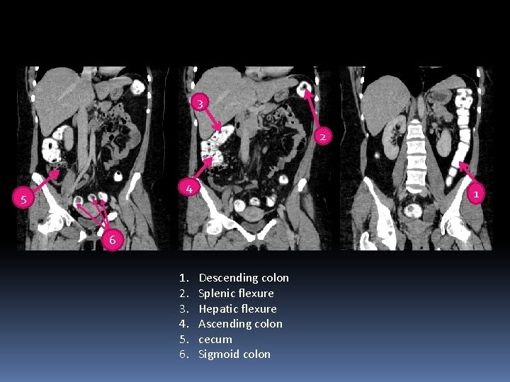 3 2 4 5 1 6 1. 2. 3. 4. 5. 6. Descending colon