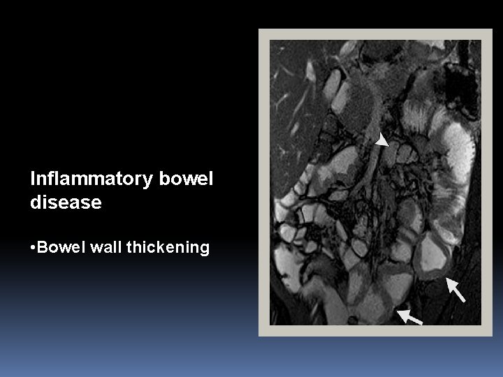 Inflammatory bowel disease • Bowel wall thickening 