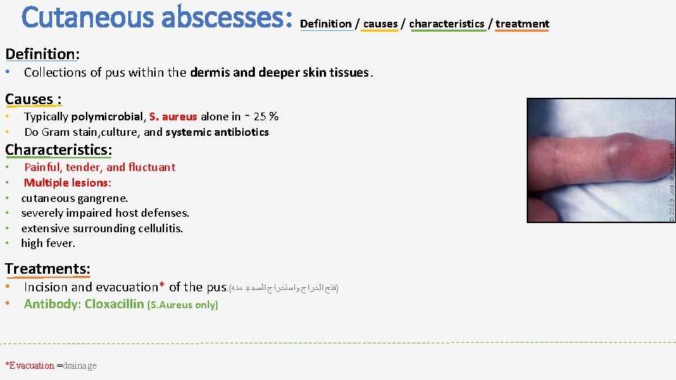 Cutaneous abscesses: Definition / causes / characteristics / treatment Definition: • Collections of pus