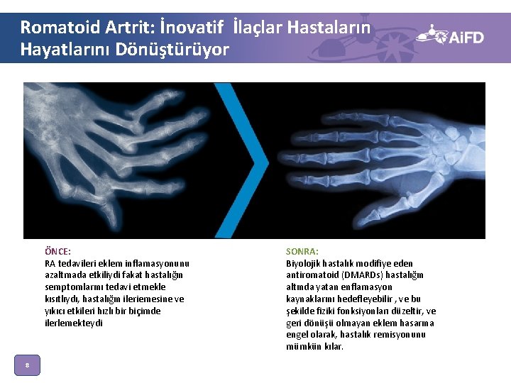 Romatoid Artrit: İnovatif İlaçlar Hastaların Hayatlarını Dönüştürüyor HAND WITH RA ÖNCE: RA tedavileri eklem