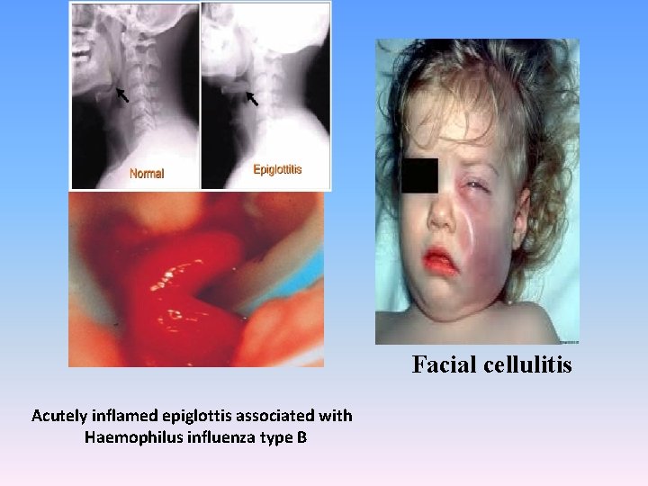 Facial cellulitis Acutely inflamed epiglottis associated with Haemophilus influenza type B 