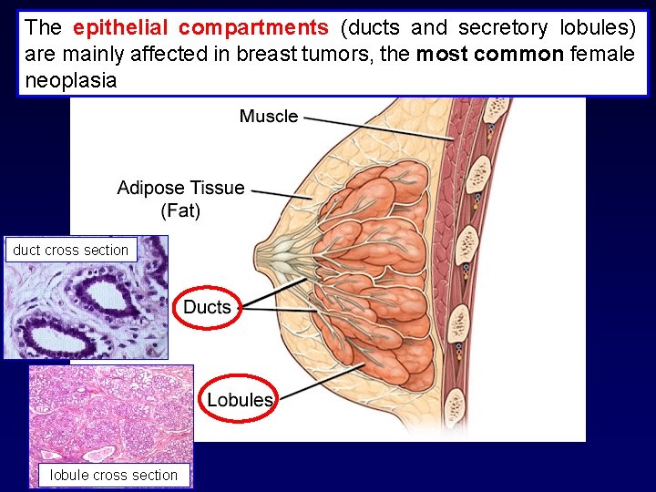 The epithelial compartments (ducts and secretory lobules) are mainly affected in breast tumors, the