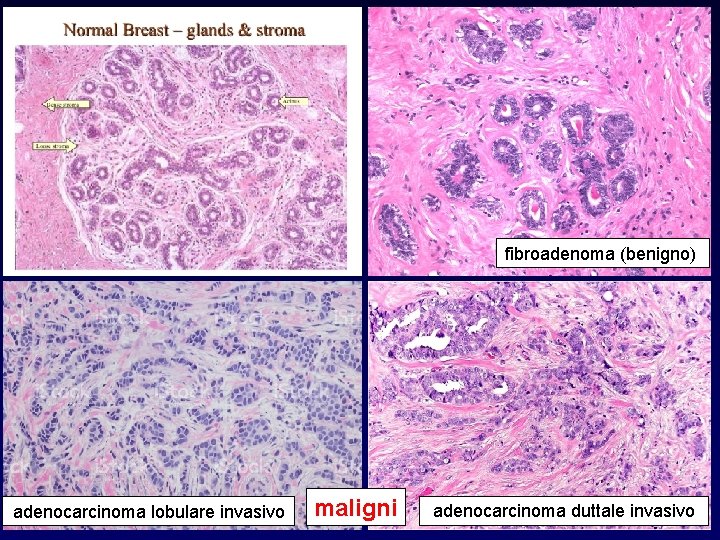 fibroadenoma (benigno) adenocarcinoma lobulare invasivo maligni adenocarcinoma duttale invasivo 
