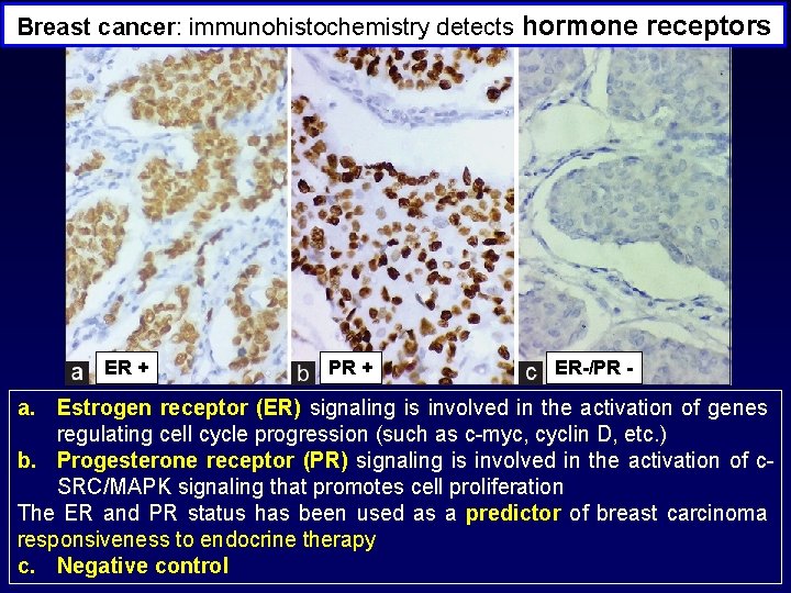 Breast cancer: immunohistochemistry detects hormone receptors ER + PR + ER-/PR - a. Estrogen