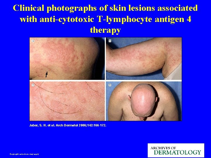 Clinical photographs of skin lesions associated with anti-cytotoxic T-lymphocyte antigen 4 therapy Jaber, S.