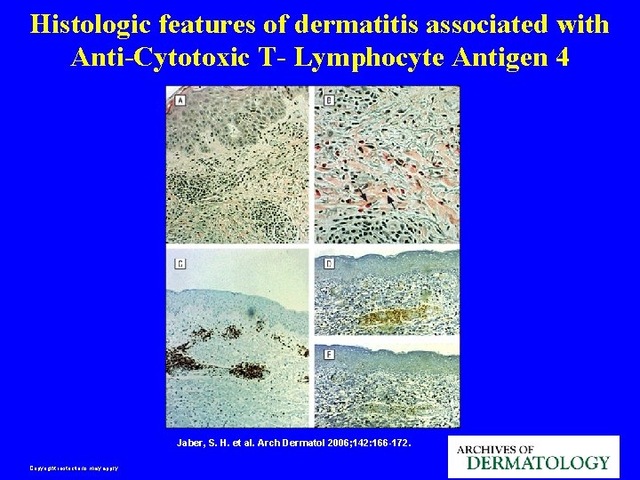 Histologic features of dermatitis associated with Anti-Cytotoxic T- Lymphocyte Antigen 4 Jaber, S. H.