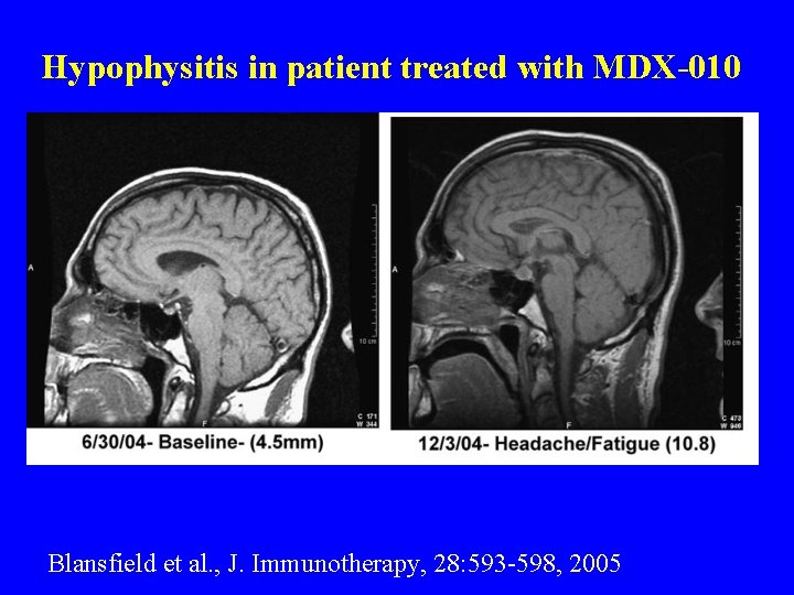 Hypophysitis in patient treated with MDX-010 Blansfield et al. , J. Immunotherapy, 28: 593