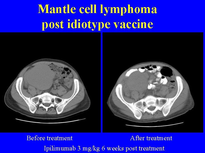 Mantle cell lymphoma post idiotype vaccine Before treatment After treatment Ipilimumab 3 mg/kg 6