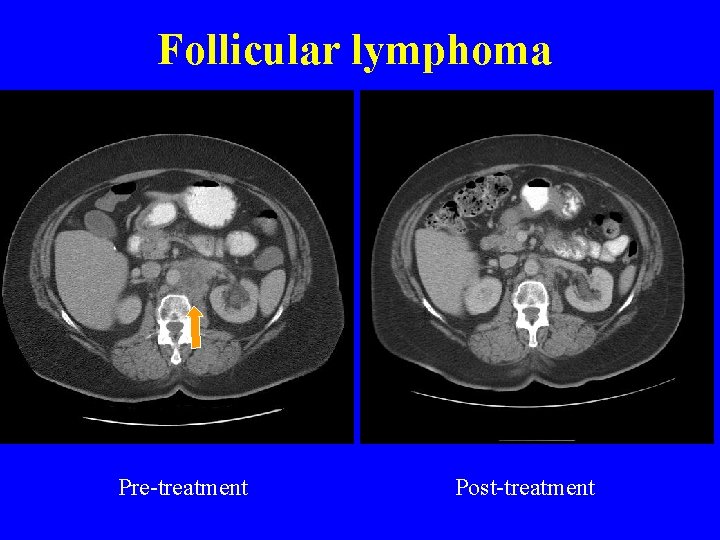 Follicular lymphoma Pre-treatment Post-treatment 