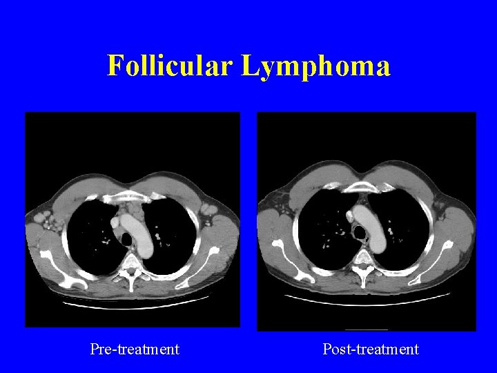 Follicular Lymphoma Pre-treatment Post-treatment 