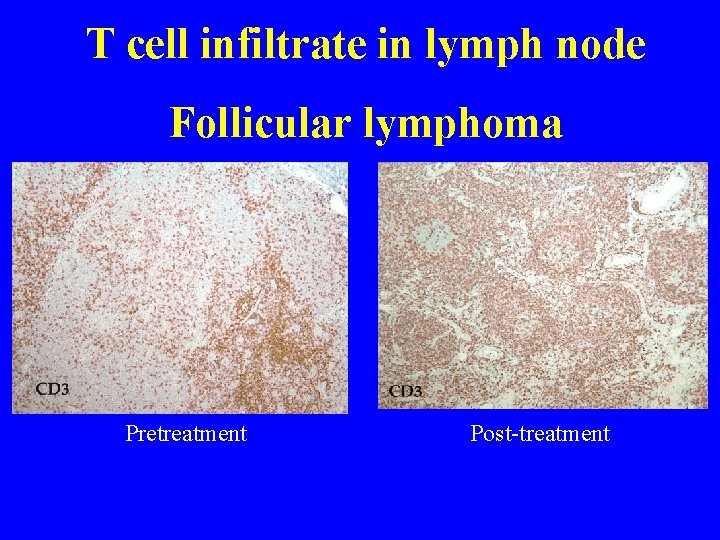 T cell infiltrate in lymph node Follicular lymphoma Pretreatment Post-treatment 