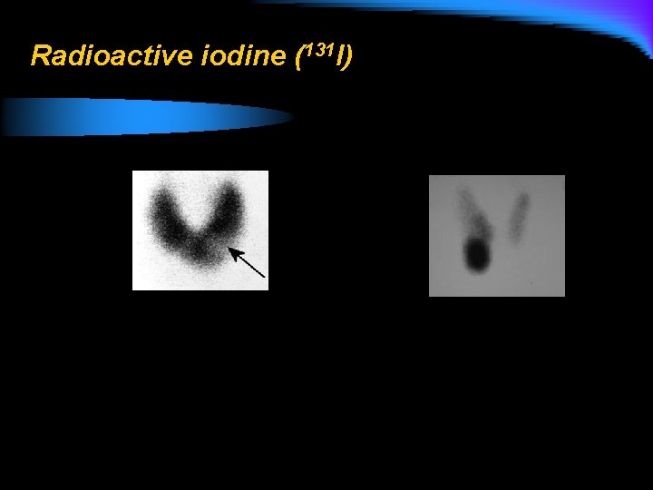 Radioactive iodine (131 I) 