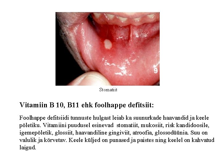 Stomatiit Vitamiin B 10, B 11 ehk foolhappe defitsiit: Foolhappe defitsiidi tunnuste hulgast leiab