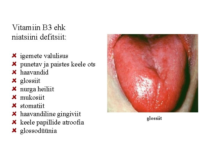 Vitamiin B 3 ehk niatsiini defitsiit: igemete valulisus punetav ja paistes keele ots haavandid