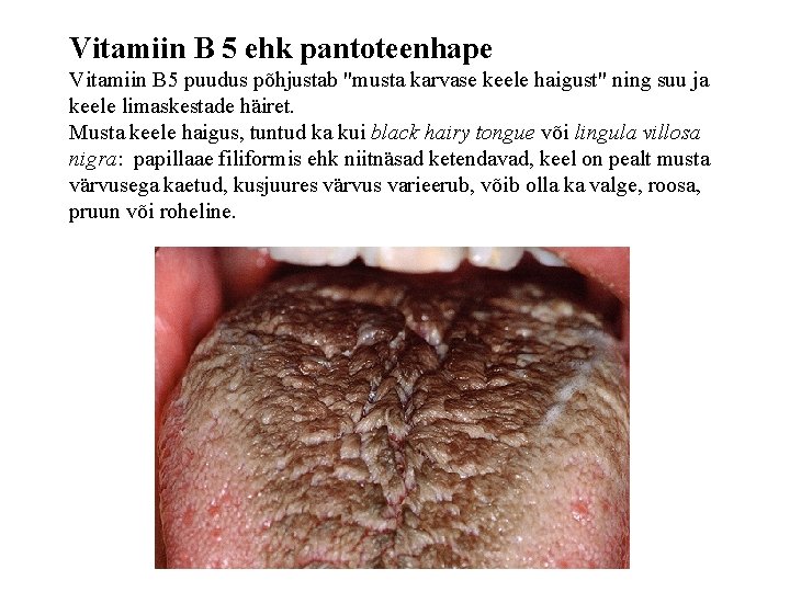 Vitamiin B 5 ehk pantoteenhape Vitamiin B 5 puudus põhjustab "musta karvase keele haigust"