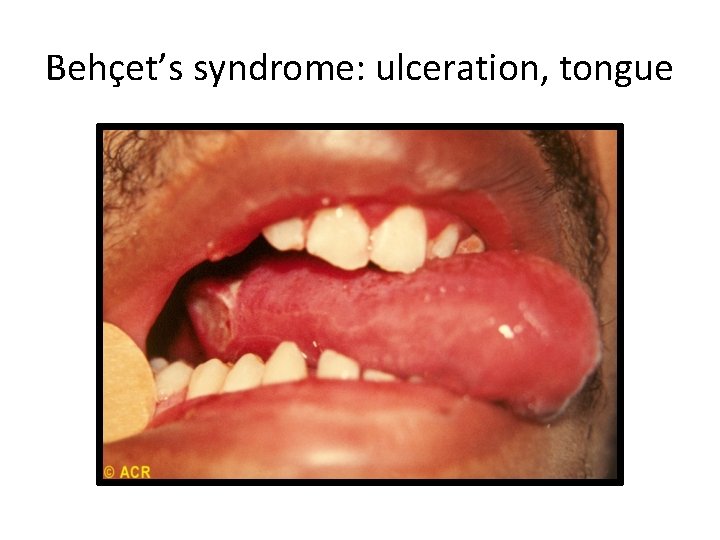 Behçet’s syndrome: ulceration, tongue 