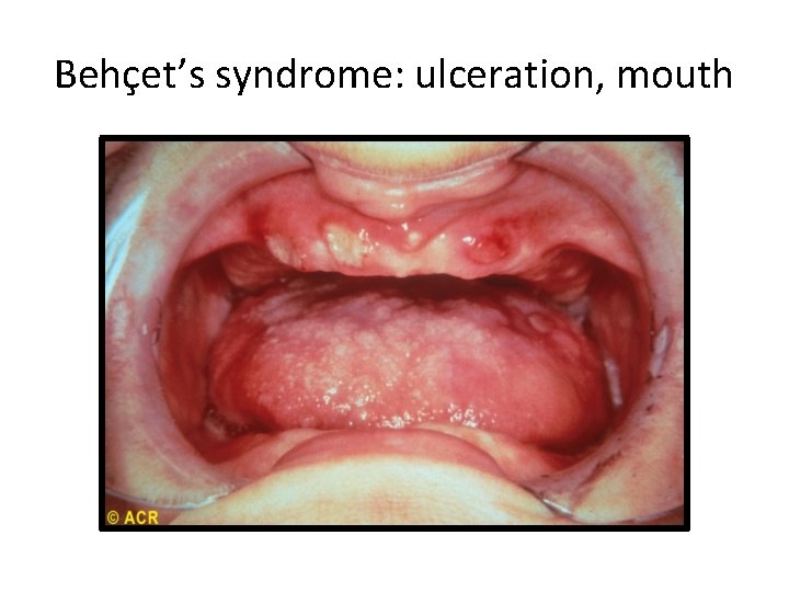 Behçet’s syndrome: ulceration, mouth 
