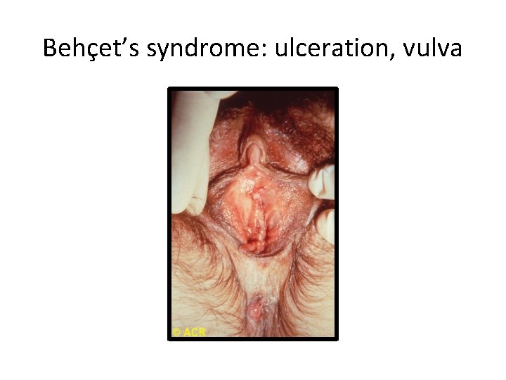 Behçet’s syndrome: ulceration, vulva 