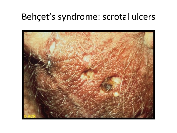 Behçet’s syndrome: scrotal ulcers 